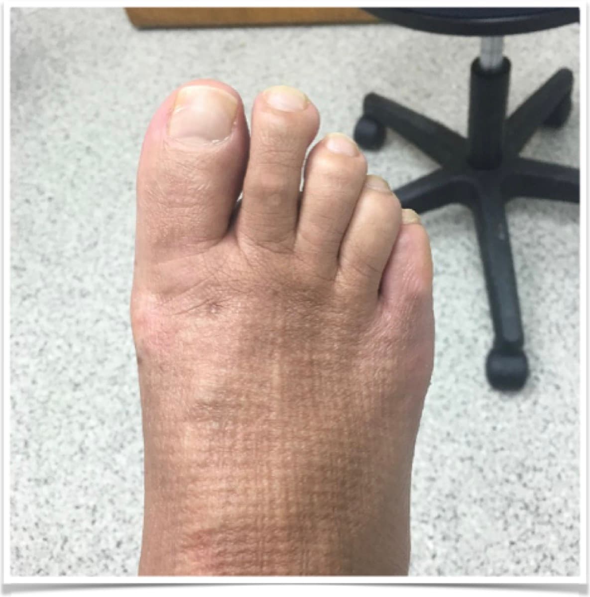 MIS Bunion Correction, after