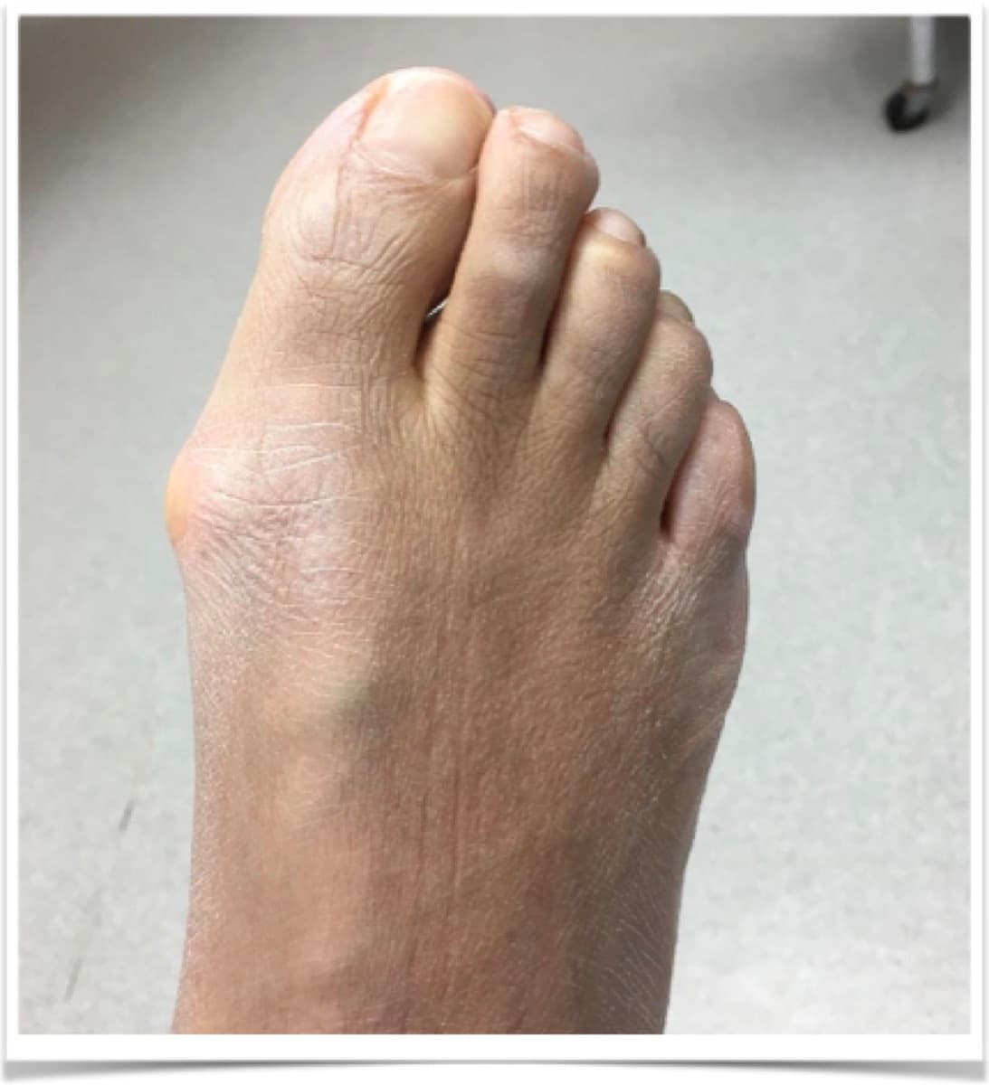 MIS Bunion Correction, before