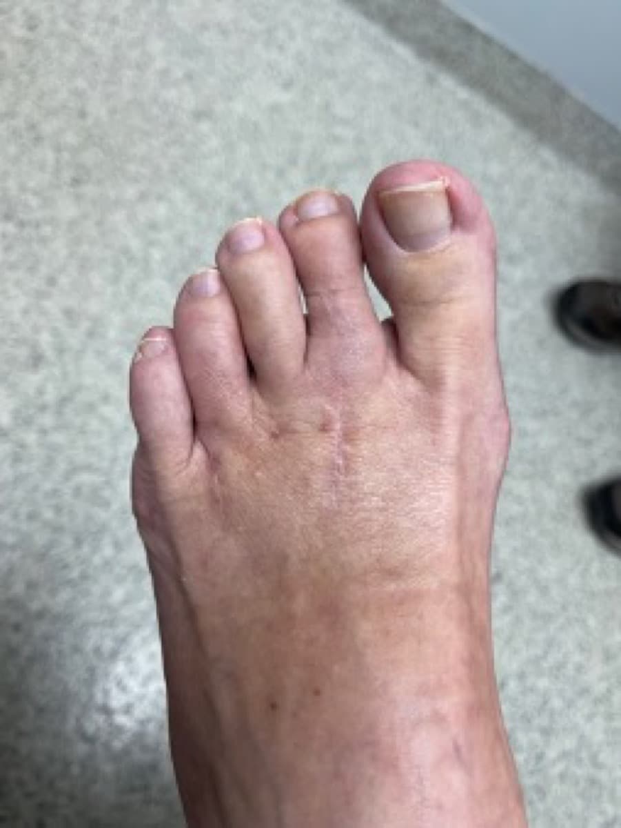 MIS Hammertoe, after