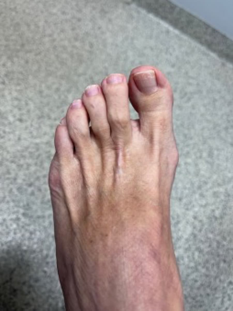 MIS Hammertoe, before