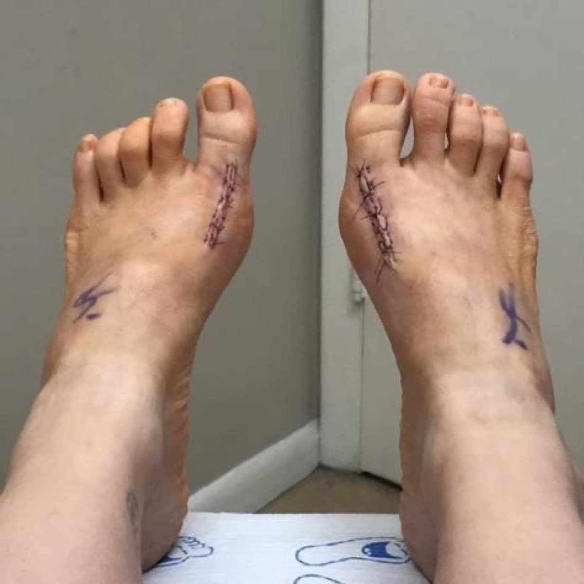 Open bunion surgery: long dorsal incisions