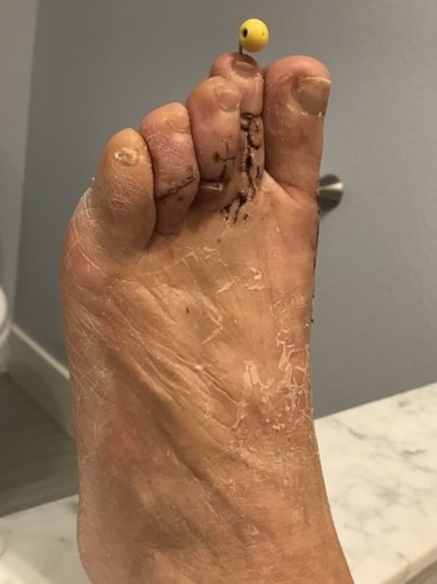 Pin fixation through the toe