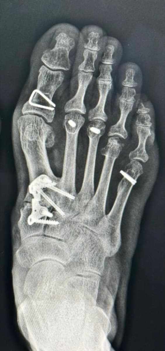 Hardware that often needs removal surgery